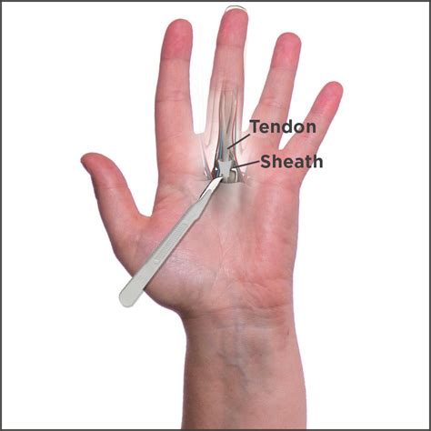Trigger Finger Stenosing Tenosynovitis Surgery Remedies And Therapy
