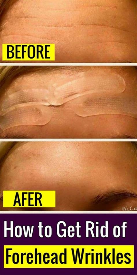 How To Get Rid Of Forehead Wrinkles Best Natural Tips To Remove Forehead Lines Forehead