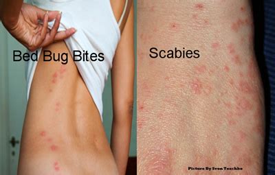 Difference Between Scabies And Fungal Infection