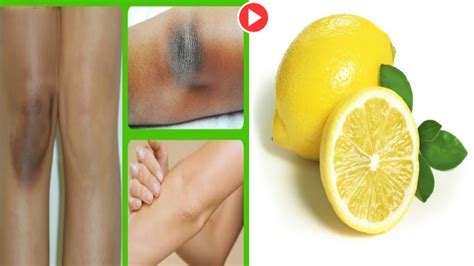 Whiten Your Dark Knees And Dark Elbows Permanentlynaturally And Remove