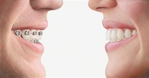 Invisalign In Charlotte Nc Braces By Bird Straighter Smile