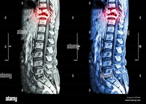 Spine Metastasis Cancer Spread To Thoracic Spine Mri Of Thoracic