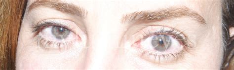 Before And After Photos Of Laser Eye Color Change Surgery
