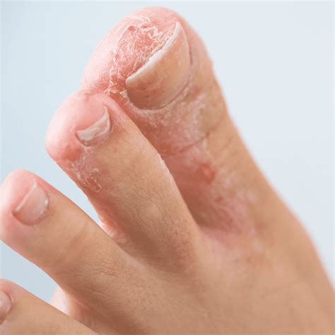 Athlete S Foot Symptoms Causes Treatment The Feet People