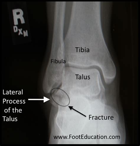 Lateral Talar Process Fractures Footeducation