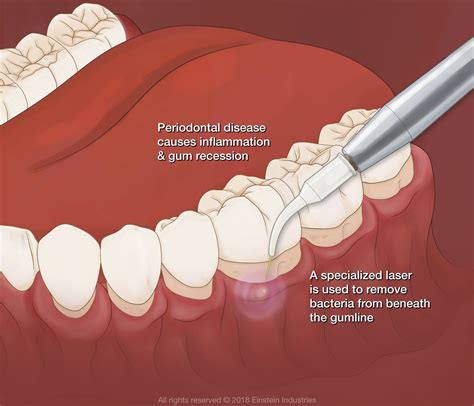 Laser Dentistry Merritt Island Fl Family Dentistry Prosthodontics Waterlase For Gum Disease