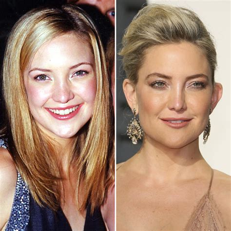 Did Kate Hudson Get A Nose Job Experts Weigh In On Her Plastic Surgery
