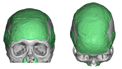 Plastic Surgery Case Study Secondary Skull Augmentation Using A 3d