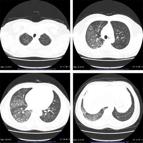 Chest High Resolution Computed Tomography On Admission At The First