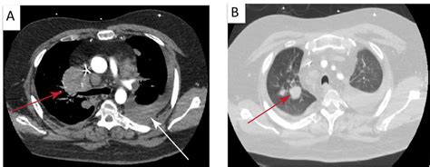 Computed Tomography Angiography Cta Of The Thorax Showing Enlarged