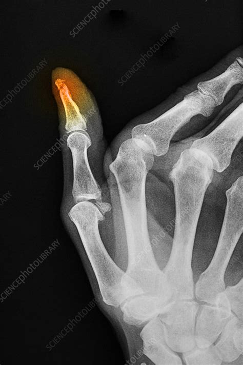X Ray Of Thumb Fracture Stock Image C0123896