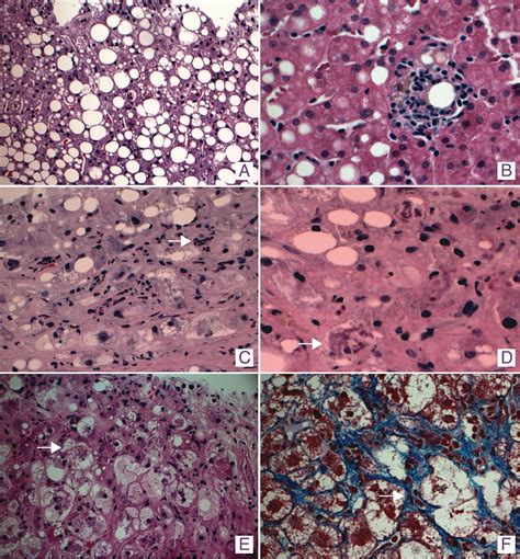 Pathology Of Alcoholic Liver Disease