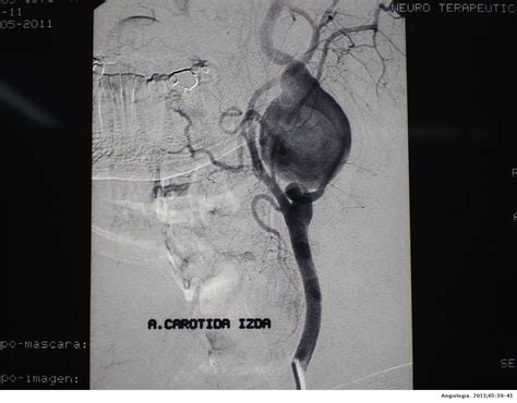 Aneurisma Sacular No Segmento Oftálmico Da Artéria Carótida Interna Esquerda