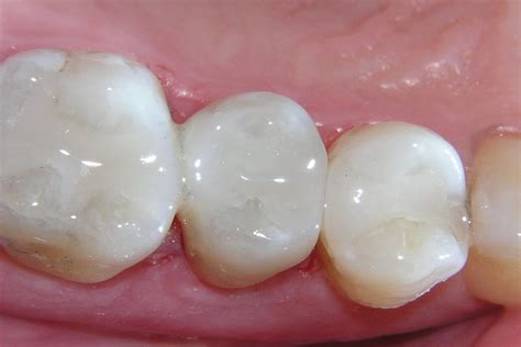 White Fillings Preston Dental Group