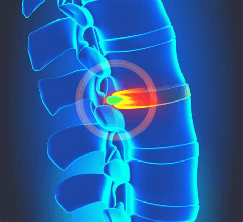 Famous physical therapists bob schrupp and brad heineck describe different ways to sleep at night when you have a herniated disk. How To Sleep With Herniated Disc: The Ultimate Guide