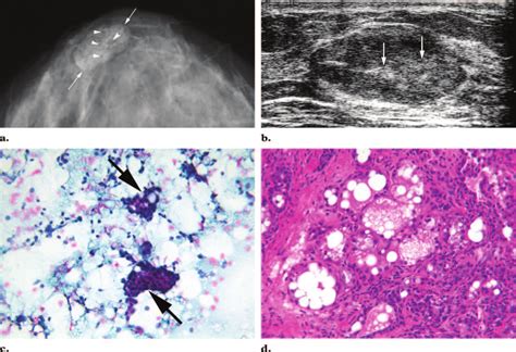 Lactating Adenoma A Mammogram Shows An Oval Circumscribed Mass