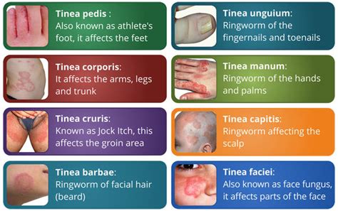 Ringworm Treatment Home Remedies How To Get Rid Of Ringworm