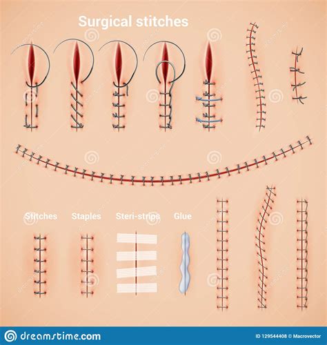 Surgical Stitches Infographic Set Stock Vector Illustration Of