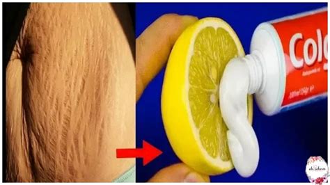 How To Get Rid Of Stretch Marks And Scars Fast At Home Remedy Youtube