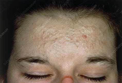 Acne Vulgaris Scarring Over A Womans Forehead Stock Image M108