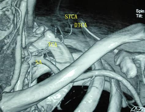 Extended Supraclavicular Fasciocutaneous Island Flap Based On The