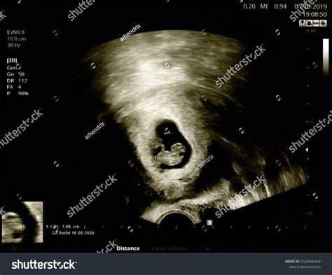 2030 2 Months Pregnancy Images Stock Photos And Vectors Shutterstock