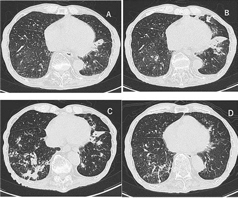 Figure 2 From Mycobacterium Avium Complex Lung Disease In A Patient