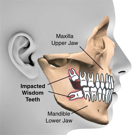 Impacted Wisdom Teeth Pacific Oral Surgery