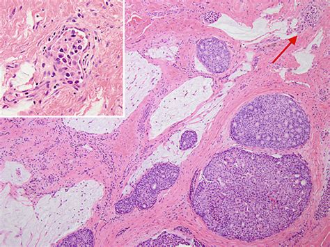 An Infiltrative Carcinoma With Cribriform Architecture And Associated