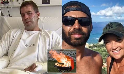 Man Is Seriously Burned After He Was ‘engulfed By A Fireball In A Buck