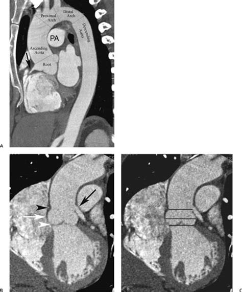 Thoracic Aorta Radiology Key