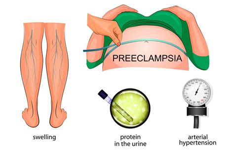 Preeclampsia And Eclampsia Guide Causes Symptoms And Treatment Options