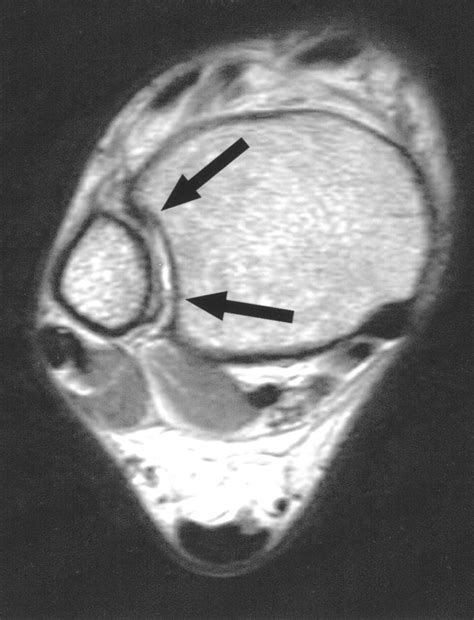 Mri Findings Associated With Distal Tibiofibular Syndesmosis Injury Ajr