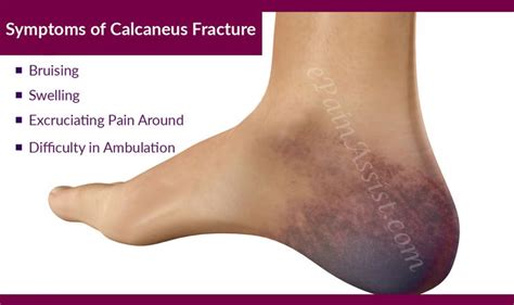 Symptoms Of Calcaneus Fracture Or Broken Heel Calcaneus Fracture