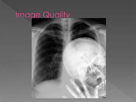 Intensifying Screen X Ray Ppt