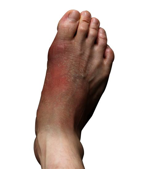 Foot Infections Chicopee Diabetic Foot Infections Springfield East