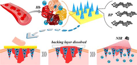 Black Phosphorus Loaded Separable Microneedles As Responsive Oxygen