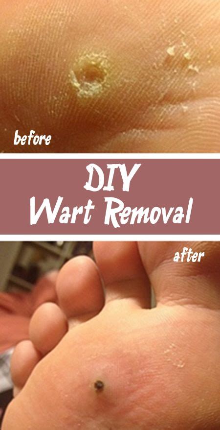 If these foot warts appear in clusters they are called mosaic warts. DIY Wart Removal | Game, Toe and Products
