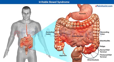 Irritable Bowel Syndrome Ibs Treatment Symptoms Signs Types