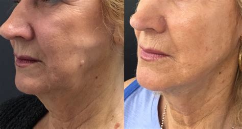 Jowl Lift With Thread Lift Hifu Tightening Or Cheek Or Jowl Fillers