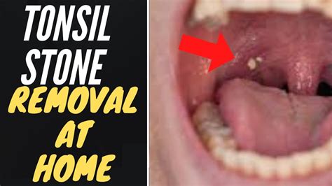 Tonsil Stones How To Remove And Prevent Tonsil Stones At Home Youtube