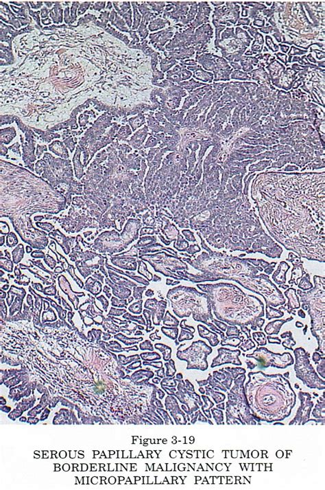 Pathology Outlines Serous Borderline Tumor Atypical Proliferative