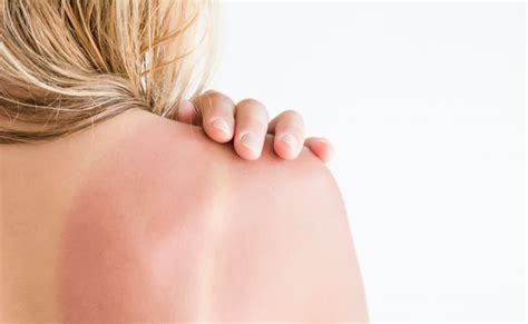 Damage Control 101 What To Do When You Get Sunburned Cure For