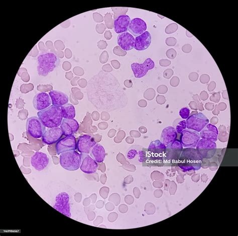 Acute Myeloid Leukemia Smear Show Monocytes And Mostly Blast Cell