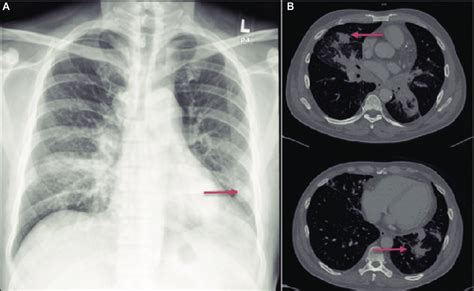 Ct Scan Of Chest Showing Right Lung Nodule Arrow On Left Panel And Images