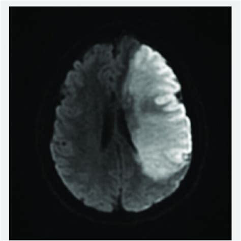 Diffusion Weighted Imaging Mri Photograph Of Patients Ischemic Stroke