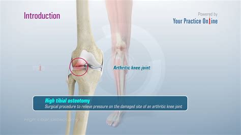 High Tibial Osteotomy Procedure
