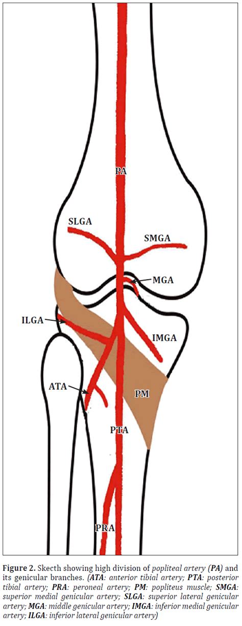 High Division Of The Popliteal Artery A Case Report