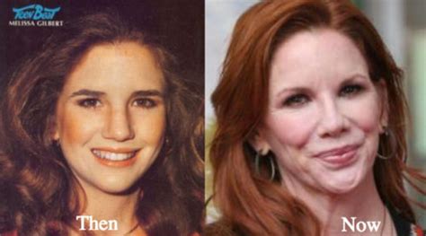 Melissa Gilbert Plastic Surgery Before And After Photos