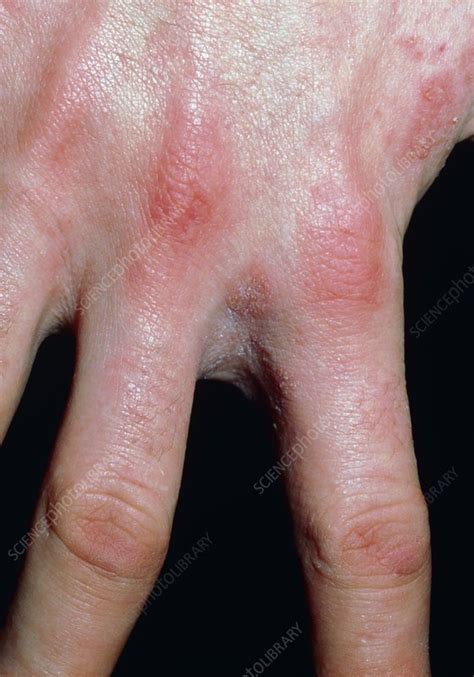 Scabies Infection On The Hand And Fingers Stock Image M2600120